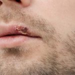 Herpes