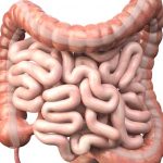 Infarctul-intestinal